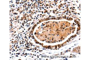 Immunohistochemistry of Human stomach cancer using DNMT3A Polyclonal Antibody at dilution of 1:65 (DNMT3A Antikörper)