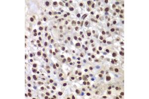 Immunohistochemistry of paraffin-embedded mouse cancer using SMARCB1 antibody (ABIN5973389) at dilution of 1/200 (40x lens). (SMARCB1 Antikörper)