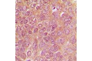 Immunohistochemical analysis of TPH1 staining in human breast cancer formalin fixed paraffin embedded tissue section. (Tryptophan Hydroxylase 1 Antikörper)