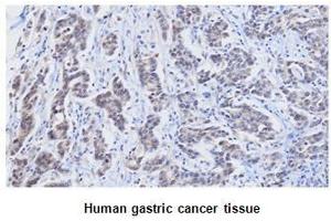 Paraffin embedded sections of human gastric canitrocelluloseer tissue were initrocelluloseubated with anti-human RBP4 (1:25) for 2 hours at room temperature. (RBP4 Antikörper  (AA 19-201))