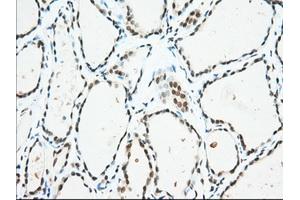 Immunohistochemical staining of paraffin-embedded Adenocarcinoma of Human colon tissue using anti-USP5 mouse monoclonal antibody. (USP5 Antikörper)