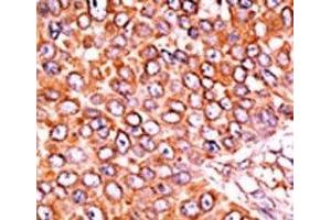 IHC analysis of FFPE human breast carcinoma tissue stained with the phospho-p27Kip1 antibody. (CDKN1B Antikörper  (pThr157))