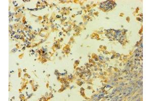 Immunohistochemistry of paraffin-embedded human cervical cancer using ABIN7155116 at dilution of 1:100 (HNRNPH1 Antikörper  (AA 2-449))
