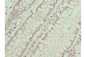Immunohistochemistry of paraffin-embedded human colon cancer using ABIN7144195 at dilution of 1:100 (ASB7 Antikörper  (AA 1-274))