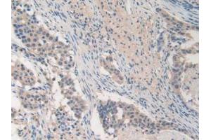 IHC-P analysis of Human Lung Cancer Tissue, with DAB staining. (MMP19 Antikörper  (AA 98-508))