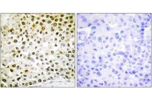 Immunohistochemistry analysis of paraffin-embedded human breast carcinoma tissue, using Histone H2B (Ab-15) Antibody. (Histone H2B Antikörper  (AA 11-60))