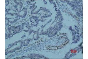 Immunohistochemistry (IHC) analysis of paraffin-embedded Human Colon Carcicnoma using Survivin Monoclonal Antibody. (Survivin Antikörper)