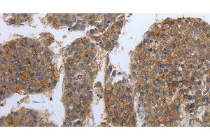 Immunohistochemistry of paraffin-embedded Human liver cancer tissue using PDIA2 Polyclonal Antibody at dilution 1:50 (PDIA2 Antikörper)