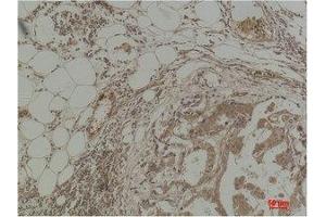 Immunohistochemistry (IHC) analysis of paraffin-embedded Human Breast Carcinoma using Pan Methylated Lysine Monoclonal Antibody. (Methylated Lysine (pan) Antikörper)