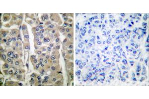 Peptide - +Immunohistochemical analysis of paraffin-embedded human breast carcinoma tissue using Involucrin antibody (#C0236). (Involucrin Antikörper)