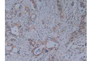 IHC-P analysis of Human Pancreas Cancer Tissue, with DAB staining. (Fibrillin 1 Antikörper  (AA 246-389))