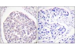 Immunohistochemistry analysis of paraffin-embedded human breast carcinoma, using IR (Phospho-Tyr1355) Antibody. (IR (AA 1326-1375), (pTyr1355) Antikörper)