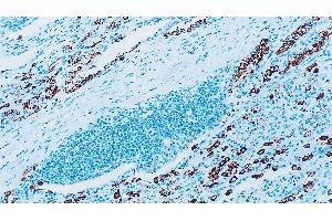 Human lung adenocarcinoma: immunohistochemical staining for Surfactant Protein A. (Surfactant Protein A1 Antikörper)