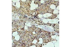 Immunohistochemical analysis of HER2 staining in human breast cancer formalin fixed paraffin embedded tissue section. (ErbB2/Her2 Antikörper)