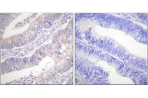 Immunohistochemistry analysis of paraffin-embedded human colon carcinoma tissue, using CFTR (Ab-737) Antibody. (CFTR Antikörper  (AA 711-760))