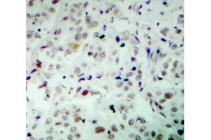 Immunohistochemistry (IHC) image for anti-Retinoblastoma 1 (RB1) (pSer780) antibody (ABIN1870571) (Retinoblastoma 1 Antikörper  (pSer780))