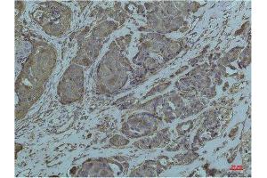 Immunohistochemistry (IHC) analysis of paraffin-embedded Human Breast Carcicnoma using GRP78/Bip Mouse Monoclonal Antibody diluted at 1:200. (GRP78 Antikörper)