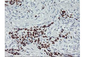 Immunohistochemical staining of paraffin-embedded Carcinoma of Human lung tissue using anti-TP53 mouse monoclonal antibody. (p53 Antikörper)