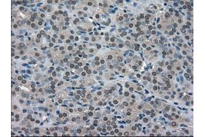 Immunohistochemical staining of paraffin-embedded Adenocarcinoma of ovary tissue using anti-SOD1mouse monoclonal antibody. (SOD1 Antikörper)