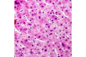 Immunohistochemical analysis of Complement C9 staining in human liver cancer formalin fixed paraffin embedded tissue section. (C9 Antikörper  (Center))