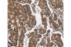 Immunohistochemistry of Human breast cancer using ITGA2 Polyclonal Antibody at dilution of 1:30 (ITGA2 Antikörper)
