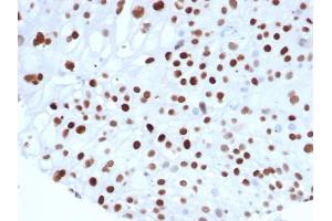 Formalin fixed paraffin embedded human colon carcinoma stained with p21 Recombinant Mouse Monoclonal Antibody (rCIP1/6907) at 2 μg/mL. (Rekombinanter p21 Antikörper  (AA 1-100))