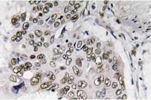 Immunohistochemistry (IHC) analyzes of Smad6 antibody in paraffin-embedded human lung carcinoma tissue. (SMAD6 Antikörper)