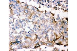 IHC-P: GFRA1 antibody testing of human lung cancer tissue (GFRA1 Antikörper  (AA 25-227))