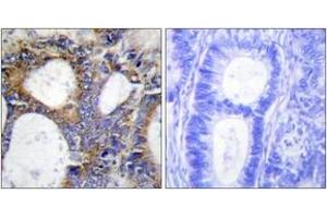 Immunohistochemistry analysis of paraffin-embedded human colon carcinoma tissue, using Collagen I alpha2 Antibody. (COL1A2 Antikörper  (AA 471-520))
