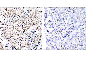 P-Peptide - +Immunohistochemical analysis of paraffin-embedded human breast carcinoma tissue using Chk1 (phospho-Ser345) antibody. (CHEK1 Antikörper  (pSer345))