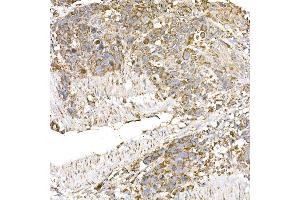 Immunohistochemistry of paraffin-embedded human esophageal cancer using GC1q R/C1QBP antibody (ABIN7266473) at dilution of 1:25 (40x lens). (C1QBP Antikörper)