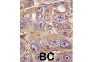 Immunohistochemistry (IHC) image for anti-Matrix Metallopeptidase 12 (Macrophage Elastase) (MMP12) antibody (ABIN2971009) (MMP12 Antikörper)