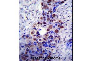 HDAC2 Antibody (C-term) (ABIN6242378 and ABIN6577318) immunohistochemistry analysis in formalin fixed and paraffin embedded human breast carcinoma followed by peroxidase conjugation of the secondary antibody and DAB staining. (HDAC2 Antikörper  (C-Term))