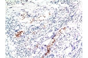 Immunohistochemical analysis of paraffin-embedded Human Breast Carcinoma Tissue using TGFβ1 Mouse mAb diluted at 1:200. (TGFB1 Antikörper)