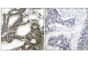 Immunohistochemical analysis of paraffin-embedded human breast carcinoma tissue, using β-Catenin (Ab-33) antibody (E021211). (beta Catenin Antikörper)