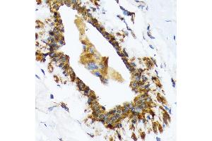 Immunohistochemistry of paraffin-embedded human breast using RAIDD/CRADD Rabbit mAb (ABIN7266107) at dilution of 1:100 (40x lens). (CRADD Antikörper)