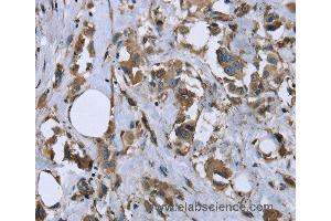 Immunohistochemistry of Human breast cancer using MYL12B Polyclonal Antibody at dilution of 1:20 (MYL12B Antikörper)