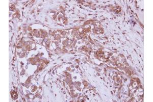 IHC-P Image Immunohistochemical analysis of paraffin-embedded human breast cancer, using P2X7, antibody at 1:250 dilution. (P2RX7 Antikörper  (Center))