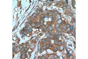 IHC analysis of paraffin-embedded human breast cancer tissue using Beclin 1 antibody at a dilution of 1:200. (Beclin 1 Antikörper)