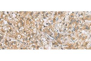 Immunohistochemistry of paraffin-embedded Human liver cancer tissue using DNPH1 Polyclonal Antibody at dilution of 1:60(x200) (RCL Antikörper)