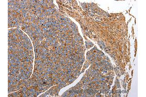 Immunohistochemistry of Human liver cancer using CD151 Polyclonal Antibody at dilution of 1:25 (CD151 Antikörper)