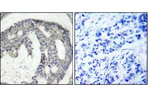 Immunohistochemistry of paraffin-embedded human breast carcinoma using Phospho-NOS3-S1177 antibody (ABIN2988223). (ENOS Antikörper  (pSer1177))