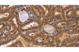 Immunohistochemistry of paraffin-embedded Human thyroid cancer tissue using CCL23 Polyclonal Antibody at dilution 1:50 (CCL23 Antikörper)