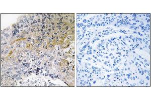 Immunohistochemical analysis of paraffin-embedded human breast carcinoma tissue using p130 Cas (Ab-410) antibody. (BCAR1 Antikörper)