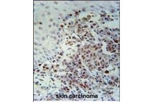 XRCC1 Antibody (Center) (ABIN651735 and ABIN2840381) immunohistochemistry analysis in formalin fixed and paraffin embedded human skin carcinoma followed by peroxidase conjugation of the secondary antibody and DAB staining. (XRCC1 Antikörper  (AA 407-435))