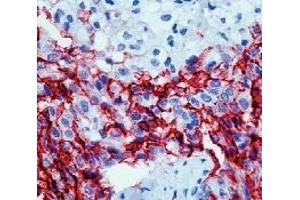 Formalin fixed paraffin embedded human mesothelioma stained with Mesothelioma antibody. (Mesothelioma Antikörper)