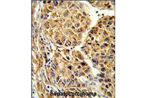 Formalin-fixed and paraffin-embedded human hepatocarcinoma reacted with CYP2C19 Antibody (N-term),which was peroxidase-conjugated to the secondary antibody, followed by DAB staining. (CYP2C19 Antikörper  (N-Term))