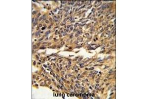 Formalin-fixed and paraffin-embedded human lung carcinoma reacted with EXOC5 Antibody (C-term), which was peroxidase-conjugated to the secondary antibody, followed by DAB staining. (EXOC5 Antikörper  (C-Term))