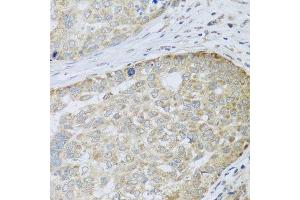 Immunohistochemistry of paraffin-embedded human liver cancer using ANAPC10 antibody. (ANAPC10 Antikörper  (AA 1-185))