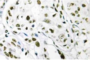 Immunohistochemistry (IHC) analyzes of Elongin A1 antibody in paraffin-embedded human breast carcinoma tissue. (TCEB3 Antikörper)